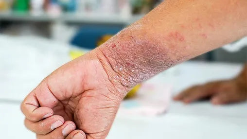 Natural Skincare and Eczema: Reviewing the Latest Research