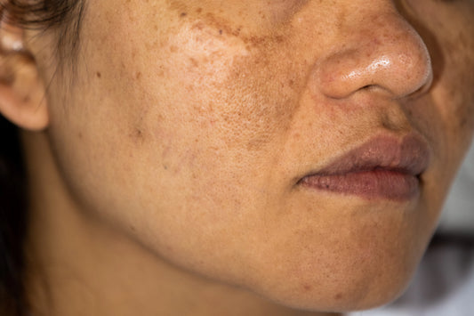 Top Essential Oils for Hyperpigmentation: Natural Remedies for Brighter, Even-Toned Skin