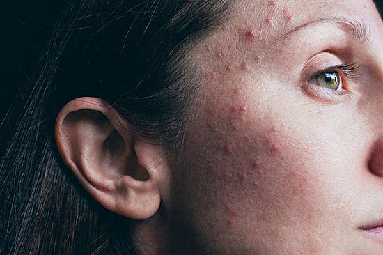 10 Natural Remedies for Oily / Acne‑Prone Skin: Essential Oils, Organic Soaps & Lifestyle Tips